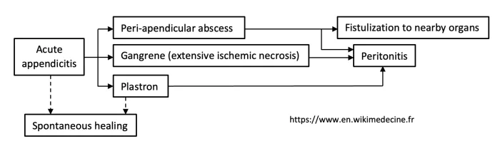 Appendicitis - evolution