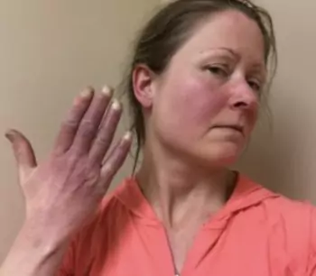 Acrocyanosis (hands and face) in a patient with postural orthostatic tachycardia syndrome