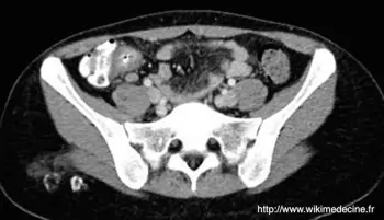 Abdominal CT-scan - Mesenteric adenitis secondary to a distal ileitis