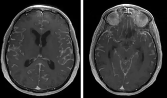 MRI - diffuse gadolinium enhancement - carcinomatous meningitis