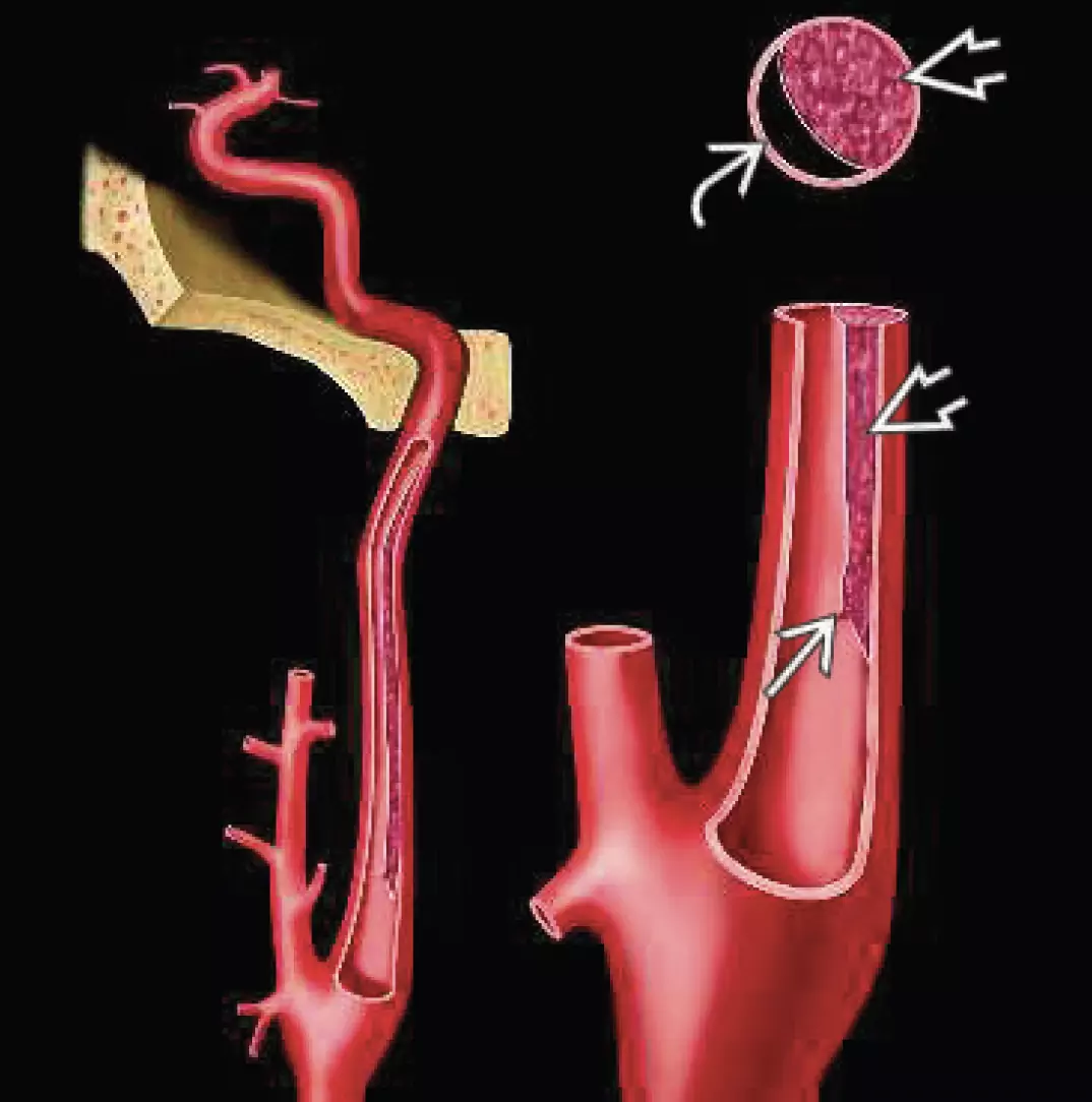 Extracranial carotid artery dissection - intimal rupture, subintimal thrombus, reduced arterial lumen