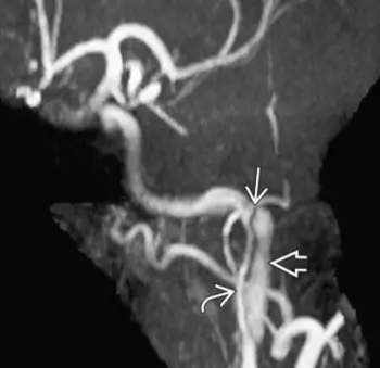 MRI - TOF - extracranial internal carotid artery dissection