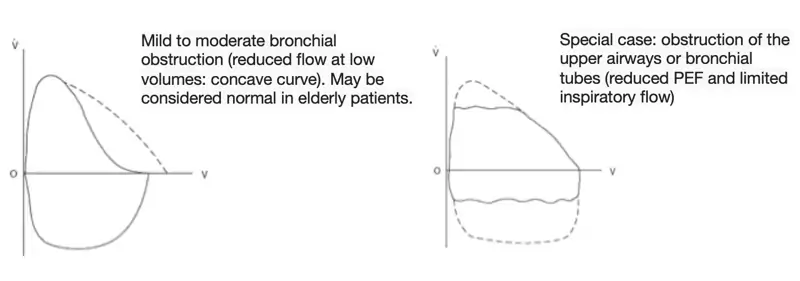 RFT - Flow-volume curves in an obstructive syndrome