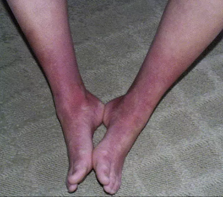 Erythromelalgia - feet