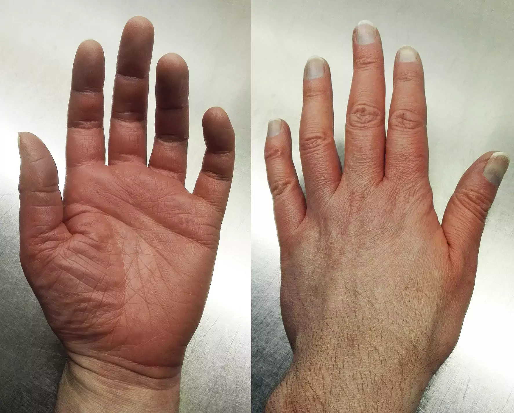 Erythromelalgia - hand