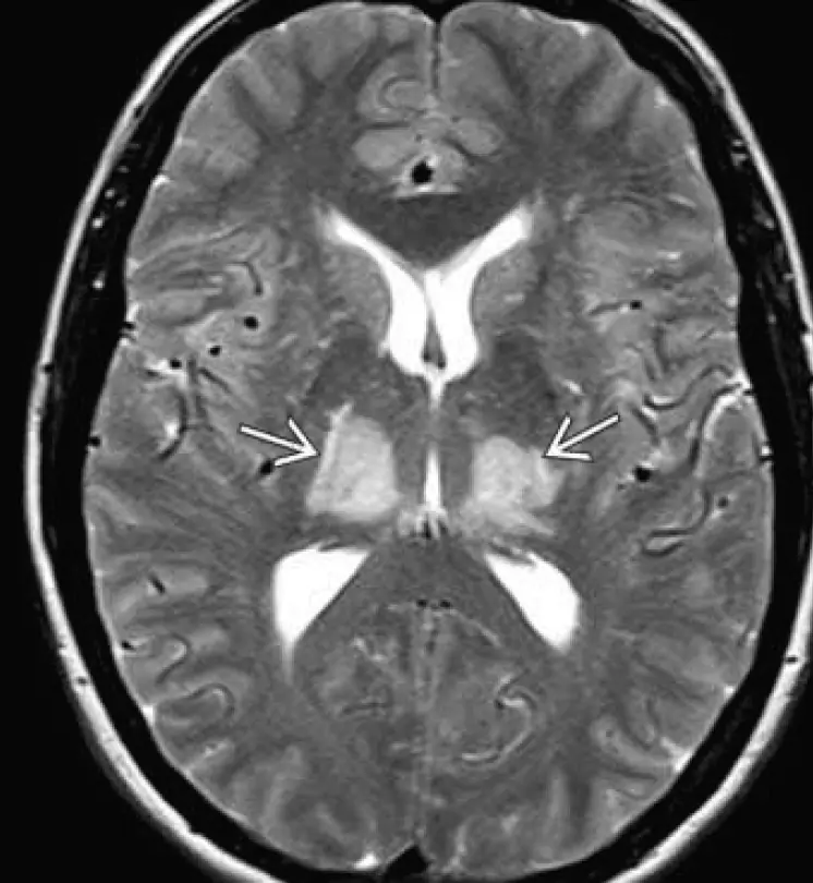 T2 MRI - hypertensive encephalopathy with lesions limited to the thalamus (total regression of lesions in this case after aggressive BP lowering)