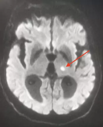 MRI - Diffusion - Recent left thalamic lacunar infarction