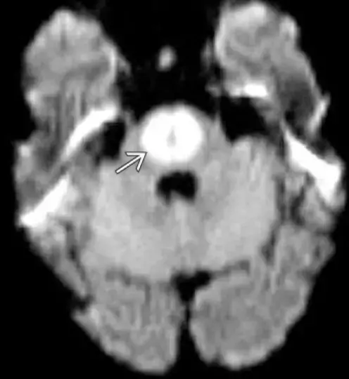 MRI - DWI sequence - centro-pontine diffusion restriction (hyperintensity)