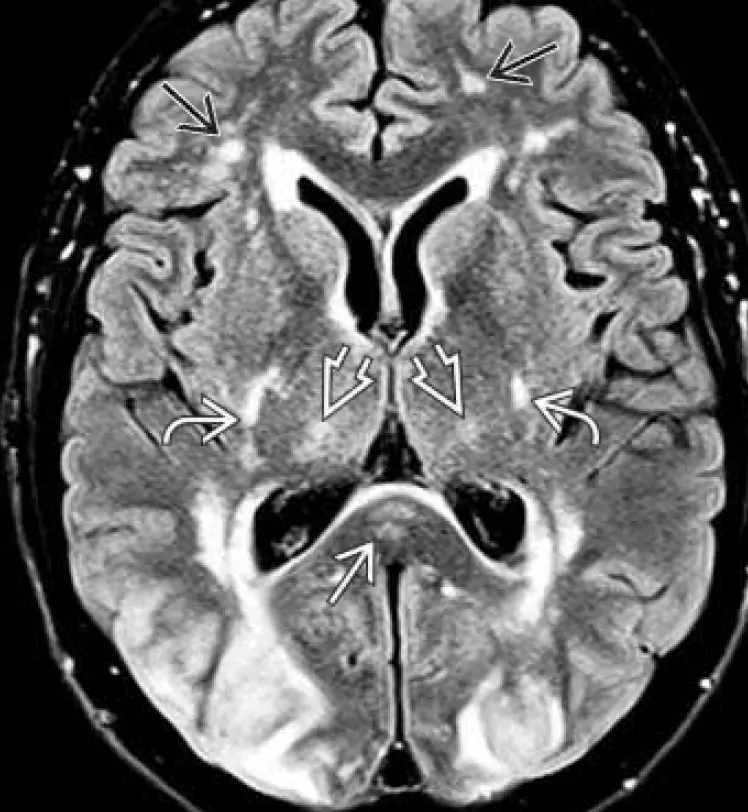 FLAIR MRI - "Atypical PRES": predominantly parieto-occipital lesions co-existing with thalamic, internal capsule, corpus callosum and frontal lesions